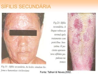 SÍFILIS SECUNDÁRIA




              Fonte: Talhari & Neves,2002.
 