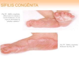 SÍFILIS CONGÊNITA
 