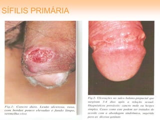 SÍFILIS PRIMÁRIA
 