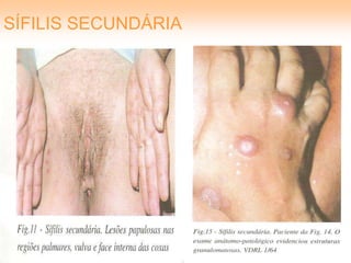 SÍFILIS SECUNDÁRIA
 