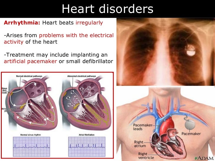 are there problems having an extra heartbeat are there problems having an extra heartbeat