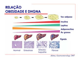 RELAÇÃO
OBESIDADE E DHGNA
                                              Tec adiposo

                                              Insulina
                                              Leptina
                                              Adiponectina
                                              Ác graxos


                                              Fígado




   Normal   Esteatose   Esteato-    Fibrose
                        hepatite
                                   Ahima, Gastroenterology 2007
 