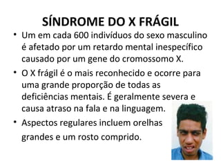 SÍNDROME DO X FRÁGIL
• Um em cada 600 indivíduos do sexo masculino
é afetado por um retardo mental inespecífico
causado por um gene do cromossomo X.
• O X frágil é o mais reconhecido e ocorre para
uma grande proporção de todas as
deficiências mentais. É geralmente severa e
causa atraso na fala e na linguagem.
• Aspectos regulares incluem orelhas
grandes e um rosto comprido.
 