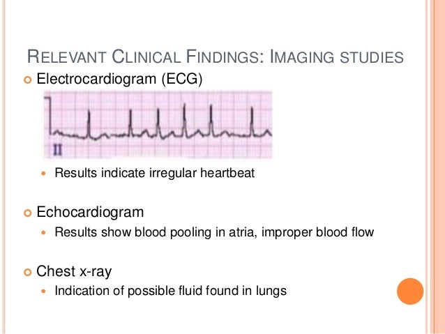 What is atrial fibrillation picture