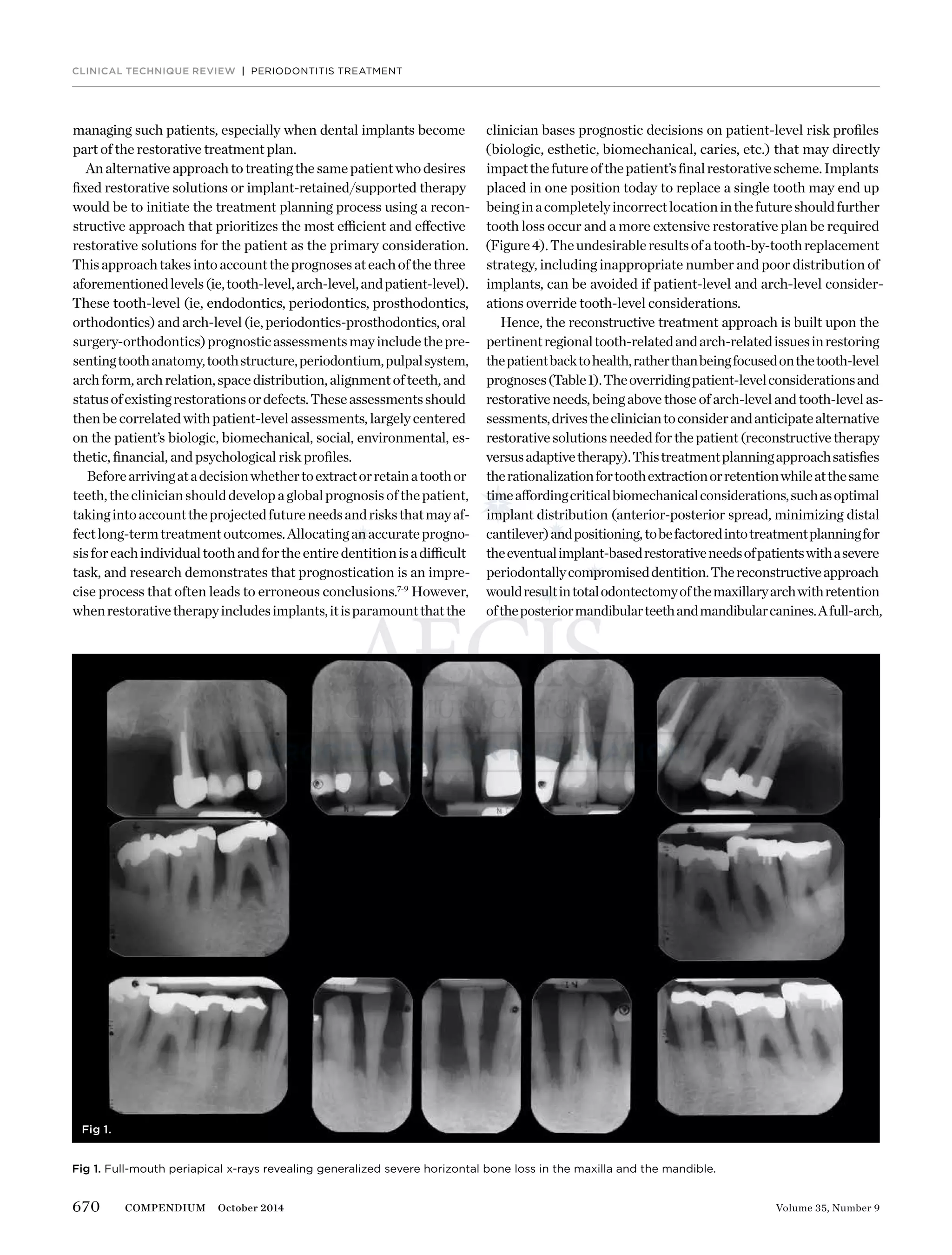 670 Volume 35, Number 9COMPENDIUM October 2014
CLINICAL TECHNIQUE REVIEW | PERIODONTITIS TREATMENT
managing such patients, especially when dental implants become
part of the restorative treatment plan.
Analternativeapproachtotreatingthesamepatientwhodesires
ﬁxed restorative solutions or implant-retained/supported therapy
would be to initiate the treatment planning process using a recon-
structive approach that prioritizes the most efficient and effective
restorative solutions for the patient as the primary consideration.
Thisapproachtakesintoaccounttheprognosesateachofthethree
aforementionedlevels(ie,tooth-level,arch-level,andpatient-level).
These tooth-level (ie, endodontics, periodontics, prosthodontics,
orthodontics) and arch-level(ie,periodontics-prosthodontics,oral
surgery-orthodontics)prognosticassessmentsmayincludethepre-
sentingtoothanatomy,toothstructure,periodontium,pulpalsystem,
archform,archrelation,spacedistribution,alignmentofteeth,and
statusofexistingrestorationsordefects.Theseassessmentsshould
thenbe correlated withpatient-levelassessments,largelycentered
on the patient’s biologic, biomechanical, social, environmental, es-
thetic, ﬁnancial, and psychological risk proﬁles.
Beforearrivingatadecisionwhethertoextractorretainatoothor
teeth,theclinicianshoulddevelopaglobalprognosisofthepatient,
takingintoaccounttheprojectedfutureneedsandrisksthatmayaf-
fectlong-termtreatmentoutcomes.Allocatinganaccurateprogno-
sisforeachindividualtoothandfortheentiredentitionisadifficult
task, and research demonstrates that prognostication is an impre-
cise process that often leads to erroneous conclusions.7-9
However,
whenrestorativetherapyincludesimplants,itisparamountthatthe
clinician bases prognostic decisions on patient-level risk proﬁles
(biologic, esthetic, biomechanical, caries, etc.) that may directly
impactthefutureofthepatient’sﬁnalrestorativescheme.Implants
placed in one position today to replace a single tooth may end up
beinginacompletelyincorrectlocationinthefutureshouldfurther
tooth loss occur and a more extensive restorative plan be required
(Figure4).Theundesirableresultsofatooth-by-toothreplacement
strategy, including inappropriate number and poor distribution of
implants, can be avoided if patient-level and arch-level consider-
ations override tooth-level considerations.
Hence, the reconstructive treatment approach is built upon the
pertinentregionaltooth-relatedandarch-relatedissuesinrestoring
thepatientbacktohealth,ratherthanbeingfocusedonthetooth-level
prognoses(Table1).Theoverridingpatient-levelconsiderationsand
restorativeneeds,beingabovethoseofarch-levelandtooth-levelas-
sessments,drivesthecliniciantoconsiderandanticipatealternative
restorativesolutionsneededforthepatient(reconstructivetherapy
versusadaptivetherapy).Thistreatmentplanningapproachsatisﬁes
therationalizationfortoothextractionorretentionwhileatthesame
timeaffordingcriticalbiomechanicalconsiderations,suchasoptimal
implant distribution (anterior-posterior spread, minimizing distal
cantilever)andpositioning,tobefactoredintotreatmentplanningfor
theeventualimplant-basedrestorativeneedsofpatientswithasevere
periodontallycompromiseddentition.Thereconstructiveapproach
wouldresultintotalodontectomyofthemaxillaryarchwithretention
oftheposteriormandibularteethandmandibularcanines.Afull-arch,
Fig 1. Full-mouth periapical x-rays revealing generalized severe horizontal bone loss in the maxilla and the mandible.
Fig 1.
 