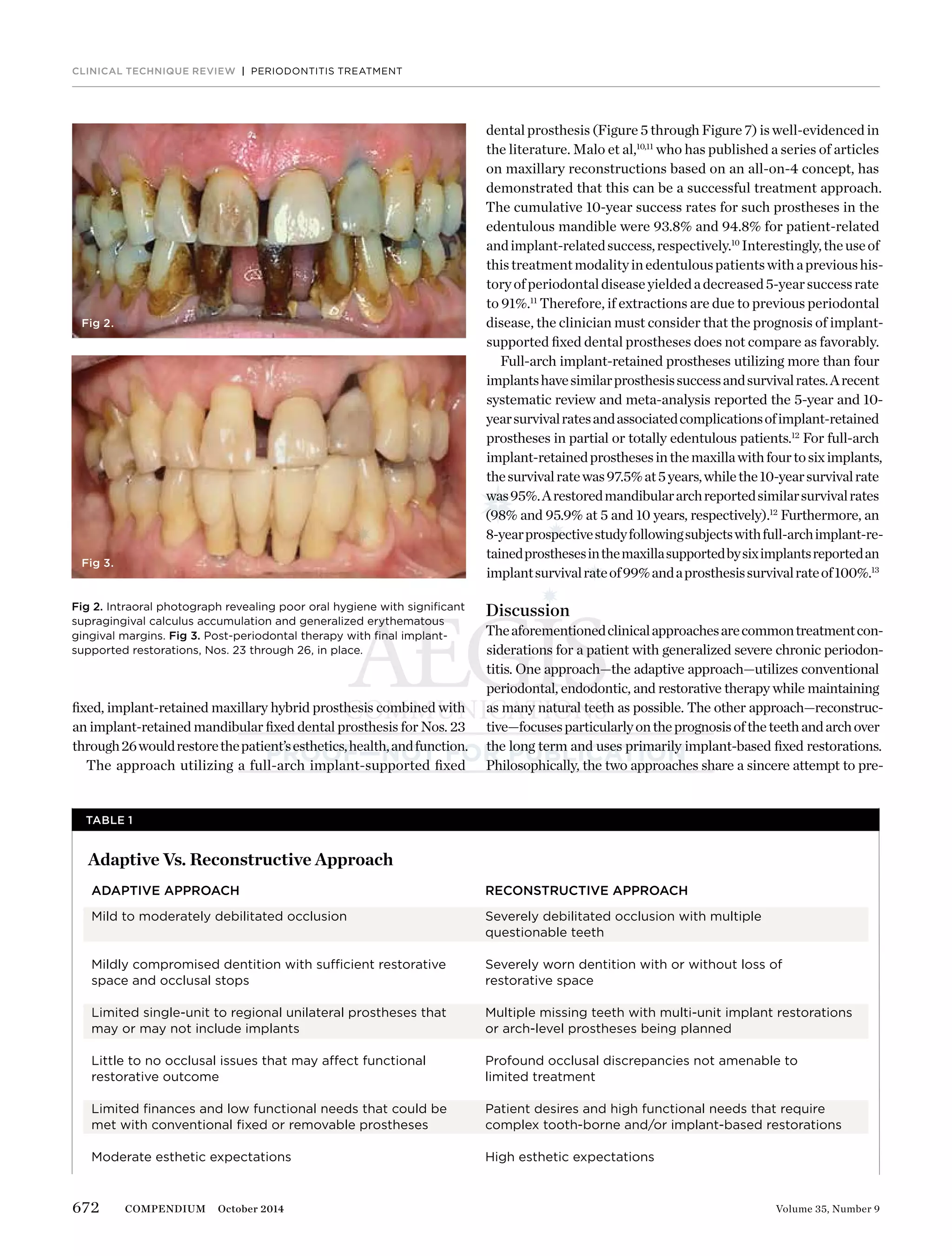 672 Volume 35, Number 9COMPENDIUM October 2014
CLINICAL TECHNIQUE REVIEW | PERIODONTITIS TREATMENT
ﬁxed, implant-retained maxillary hybrid prosthesis combined with
an implant-retained mandibular ﬁxed dental prosthesis for Nos. 23
through26wouldrestorethepatient’sesthetics,health,andfunction.
The approach utilizing a full-arch implant-supported ﬁxed
TABLE 1
Adaptive Vs. Reconstructive Approach
ADAPTIVE APPROACH
Mild to moderately debilitated occlusion
Mildly compromised dentition with sufficient restorative
space and occlusal stops
Limited single-unit to regional unilateral prostheses that
may or may not include implants
Little to no occlusal issues that may affect functional
restorative outcome
Limited ﬁnances and low functional needs that could be
met with conventional ﬁxed or removable prostheses
Moderate esthetic expectations
RECONSTRUCTIVE APPROACH
Severely debilitated occlusion with multiple
questionable teeth
Severely worn dentition with or without loss of
restorative space
Multiple missing teeth with multi-unit implant restorations
or arch-level prostheses being planned
Profound occlusal discrepancies not amenable to
limited treatment
Patient desires and high functional needs that require
complex tooth-borne and/or implant-based restorations
High esthetic expectations
Fig 2.
Fig 3.
Fig 2. Intraoral photograph revealing poor oral hygiene with signiﬁcant
supragingival calculus accumulation and generalized erythematous
gingival margins. Fig 3. Post-periodontal therapy with ﬁnal implant-
supported restorations, Nos. 23 through 26, in place.
dental prosthesis (Figure 5 through Figure 7) is well-evidenced in
the literature. Malo et al,10,11
who has published a series of articles
on maxillary reconstructions based on an all-on-4 concept, has
demonstrated that this can be a successful treatment approach.
The cumulative 10-year success rates for such prostheses in the
edentulous mandible were 93.8% and 94.8% for patient-related
andimplant-relatedsuccess,respectively.10
Interestingly,theuseof
thistreatmentmodalityinedentulouspatientswithaprevioushis-
toryofperiodontaldiseaseyieldedadecreased5-yearsuccessrate
to 91%.11
Therefore, if extractions are due to previous periodontal
disease, the clinician must consider that the prognosis of implant-
supported ﬁxed dental prostheses does not compare as favorably.
Full-arch implant-retained prostheses utilizing more than four
implantshavesimilarprosthesissuccessandsurvivalrates.Arecent
systematic review and meta-analysis reported the 5-year and 10-
yearsurvivalratesandassociatedcomplicationsofimplant-retained
prostheses in partial or totally edentulous patients.12
For full-arch
implant-retainedprosthesesinthemaxillawithfourtosiximplants,
thesurvivalratewas97.5%at5years,whilethe10-yearsurvivalrate
was95%.Arestoredmandibulararchreportedsimilarsurvivalrates
(98% and 95.9% at 5 and 10 years, respectively).12
Furthermore, an
8-yearprospectivestudyfollowingsubjectswithfull-archimplant-re-
tainedprosthesesinthemaxillasupportedbysiximplantsreportedan
implantsurvivalrateof99%andaprosthesissurvivalrateof100%.13
Discussion
Theaforementionedclinicalapproachesarecommontreatmentcon-
siderations for a patient with generalized severe chronic periodon-
titis. One approach—the adaptive approach—utilizes conventional
periodontal, endodontic, and restorative therapy while maintaining
as many natural teeth as possible. The other approach—reconstruc-
tive—focusesparticularlyontheprognosisoftheteethandarchover
the long term and uses primarily implant-based ﬁxed restorations.
Philosophically, the two approaches share a sincere attempt to pre-
 