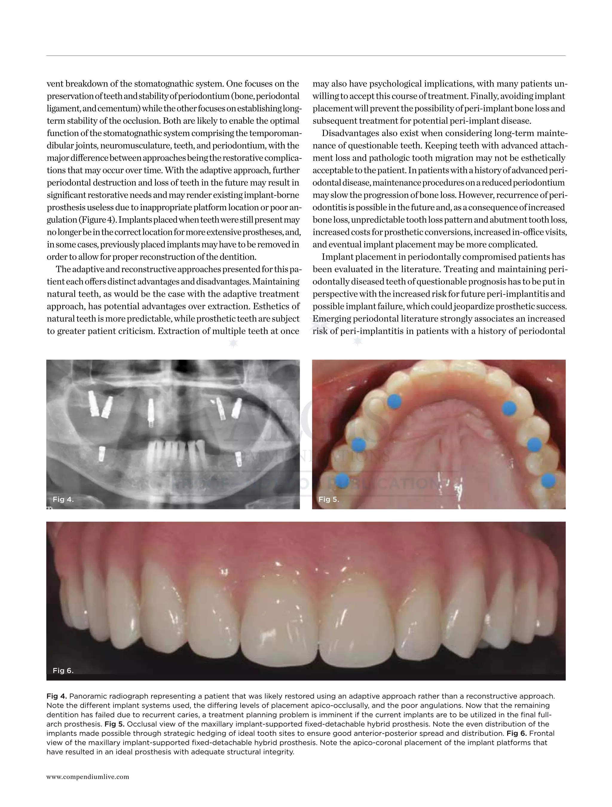 www.compendiumlive.com
vent breakdown of the stomatognathic system. One focuses on the
preservationofteethandstabilityofperiodontium(bone,periodontal
ligament,andcementum)whiletheotherfocusesonestablishinglong-
term stability of the occlusion. Both are likely to enable the optimal
functionofthestomatognathicsystemcomprisingthetemporoman-
dibular joints, neuromusculature, teeth, and periodontium, with the
majordifferencebetweenapproachesbeingtherestorativecomplica-
tions that may occur over time. With the adaptive approach, further
periodontal destruction and loss of teeth in the future may result in
signiﬁcantrestorativeneedsandmayrenderexistingimplant-borne
prosthesisuselessduetoinappropriateplatformlocationorpooran-
gulation(Figure4).Implantsplacedwhenteethwerestillpresentmay
nolongerbeinthecorrectlocationformoreextensiveprostheses,and,
insomecases,previouslyplacedimplantsmayhavetoberemovedin
ordertoallowforproperreconstructionofthedentition. 
Theadaptiveandreconstructiveapproachespresentedforthispa-
tienteachoffersdistinctadvantagesanddisadvantages.Maintaining
natural teeth, as would be the case with the adaptive treatment
approach, has potential advantages over extraction. Esthetics of
naturalteethismorepredictable,whileprostheticteetharesubject
to greater patient criticism. Extraction of multiple teeth at once
may also have psychological implications, with many patients un-
willingtoacceptthiscourseoftreatment.Finally,avoidingimplant
placementwillpreventthepossibilityofperi-implantbonelossand
subsequent treatment for potential peri-implant disease.
Disadvantages also exist when considering long-term mainte-
nance of questionable teeth. Keeping teeth with advanced attach-
ment loss and pathologic tooth migration may not be esthetically
acceptabletothepatient.Inpatientswithahistoryofadvancedperi-
odontaldisease,maintenanceproceduresonareducedperiodontium
may slow the progression of bone loss. However, recurrence of peri-
odontitisispossibleinthefutureand,asaconsequenceofincreased
boneloss,unpredictabletoothlosspatternandabutmenttoothloss,
increasedcostsforprostheticconversions,increasedin-officevisits,
and eventual implant placement may be more complicated.
Implant placement in periodontally compromised patients has
been evaluated in the literature. Treating and maintaining peri-
odontallydiseasedteethofquestionableprognosishastobeputin
perspectivewiththeincreasedriskforfutureperi-implantitisand
possibleimplantfailure,whichcouldjeopardizeprostheticsuccess.
Emerging periodontal literature strongly associates an increased
risk of peri-implantitis in patients with a history of periodontal
Fig 4. Fig 5.
Fig 6.
Fig 4. Panoramic radiograph representing a patient that was likely restored using an adaptive approach rather than a reconstructive approach.
Note the different implant systems used, the differing levels of placement apico-occlusally, and the poor angulations. Now that the remaining
dentition has failed due to recurrent caries, a treatment planning problem is imminent if the current implants are to be utilized in the ﬁnal full-
arch prosthesis. Fig 5. Occlusal view of the maxillary implant-supported ﬁxed-detachable hybrid prosthesis. Note the even distribution of the
implants made possible through strategic hedging of ideal tooth sites to ensure good anterior-posterior spread and distribution. Fig 6. Frontal
view of the maxillary implant-supported ﬁxed-detachable hybrid prosthesis. Note the apico-coronal placement of the implant platforms that
have resulted in an ideal prosthesis with adequate structural integrity.
 