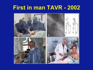 First Tavr Transcatheter Aortic Valve (TAVR) Explant | PDF