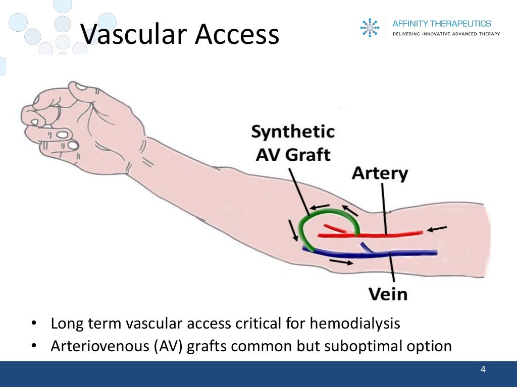 Vascular Access •Long term vascular