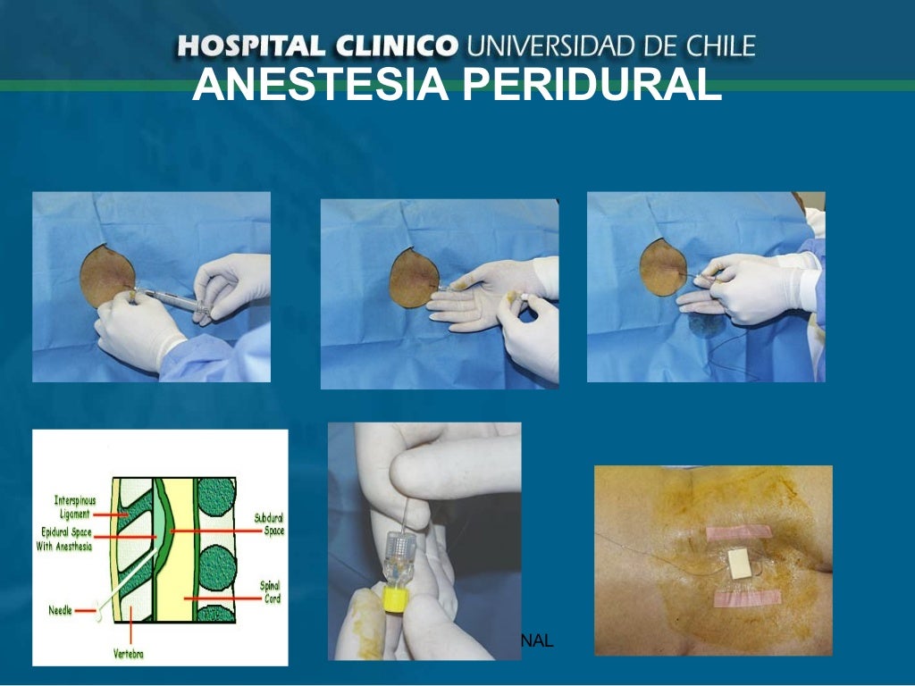 05 Anestesia Regional