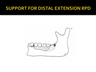 Direct retainers for Removable partial dentures 