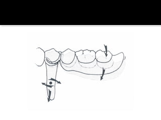 Direct retainers for Removable partial dentures 