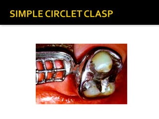 Direct retainers for Removable partial dentures 
