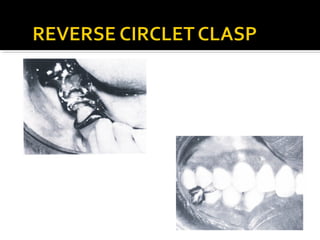 Direct retainers for Removable partial dentures 