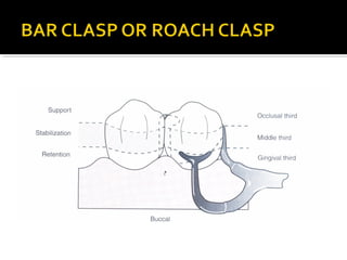 Direct retainers for Removable partial dentures 
