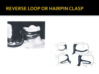 Direct retainers for Removable partial dentures 