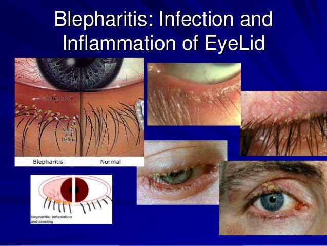 avenova blepharitis meibomian gland eyelid