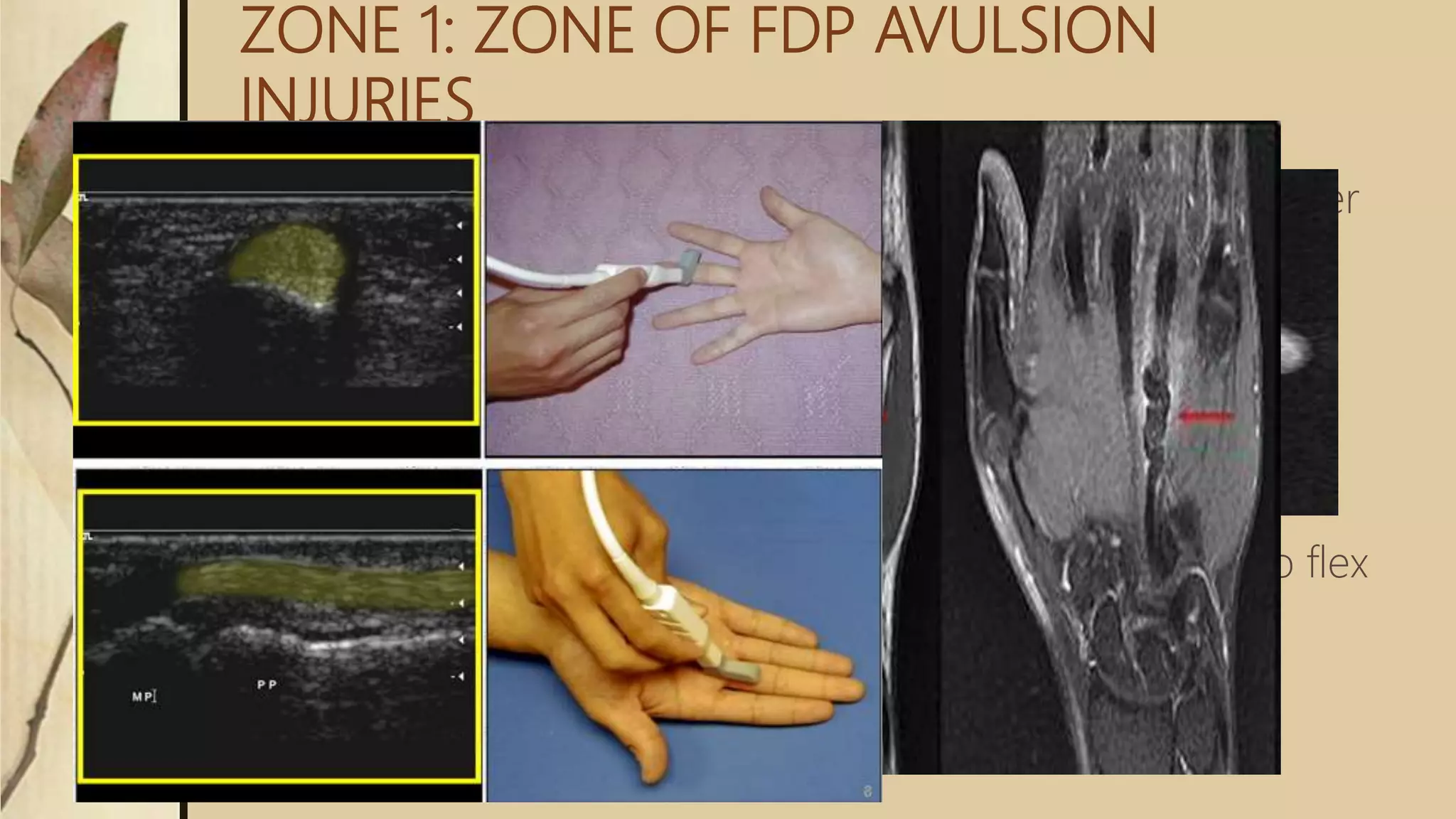 ZONE 1: ZONE OF FDP AVULSION
INJURIES
 Region b/w middle aspects of middle phalanx to finger
tips
 Contains only one tendon-fdp
 Tendon laceration occurs close to its insertion
 Tendon to bone repair is required than tendon repair
 Leddy classification of zone I flexor tendon injuries
 Type I: tendon retracted into palm (fullness in palm)
 Type II: tendon trapped in the sheath at PIP (unable to flex
PIP)
 Type III: tendon trapped in A4 pully
 