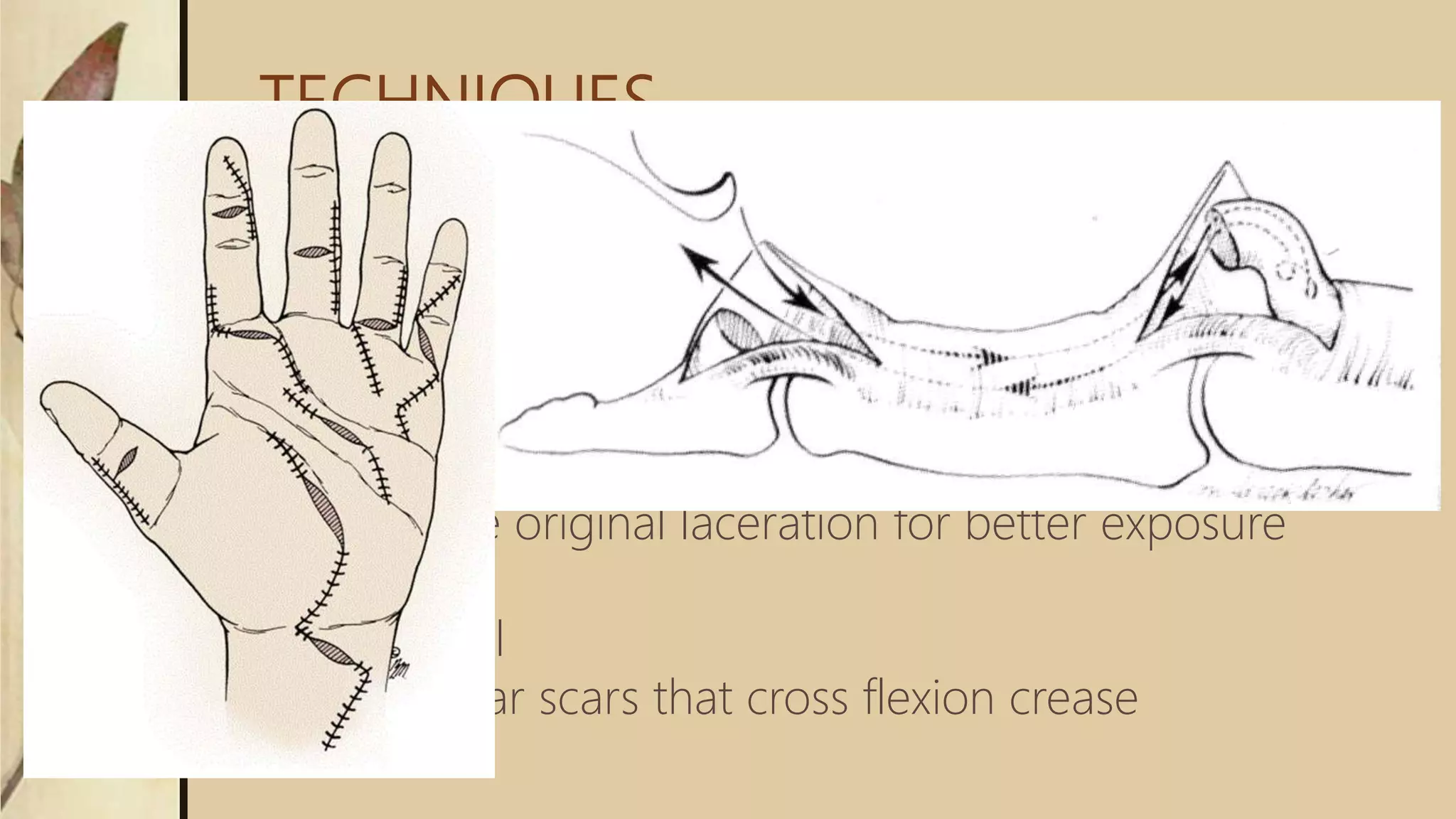 TECHNIQUES
 Retrieve the tendon ends through the sheath in an
atraumatic manner
 Maintain the integrity of the pulley system (especially
A2 and A4)
 Create “retinacular window” described by Lister for
preserving the flexor sheath
 Extend the original laceration for better exposure
 Zigzag
 Mid-lateral
 Avoid linear scars that cross flexion crease
 