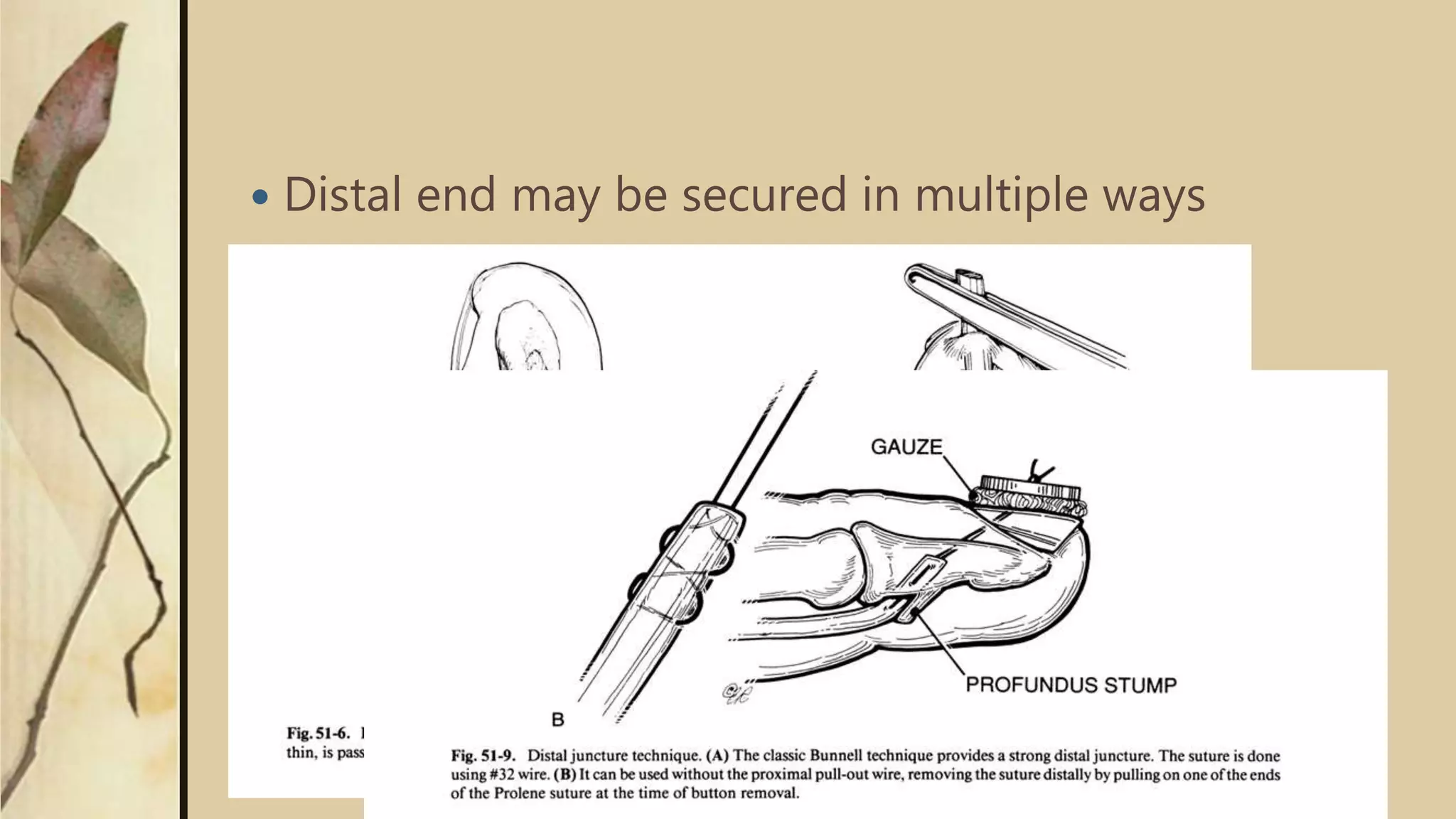  Distal end may be secured in multiple ways
 
