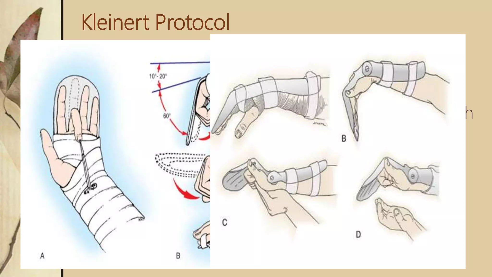 Kleinert Protocol
 Combines dorsal extension block with rubber-
band traction proximal to wrist
 Originally, included a nylon loop placed through
the nail, and around the nail is placed a rubber
band
 This passively flexes fingers, & the patient
actively extends within the limits of the splint
 