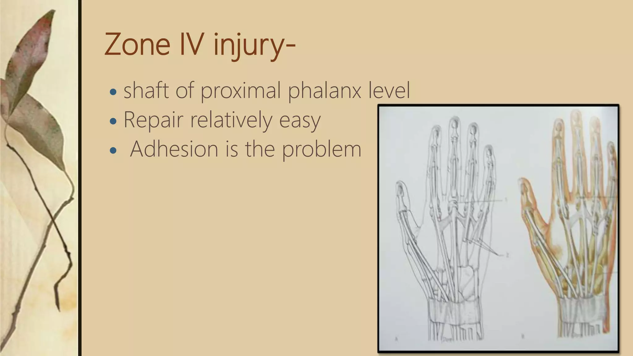 Zone IV injury-
 shaft of proximal phalanx level
 Repair relatively easy
 Adhesion is the problem
 