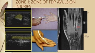 ZONE 1: ZONE OF FDP AVULSION
INJURIES
 Region b/w middle aspects of middle phalanx to finger
tips
 Contains only one tendon-fdp
 Tendon laceration occurs close to its insertion
 Tendon to bone repair is required than tendon repair
 Leddy classification of zone I flexor tendon injuries
 Type I: tendon retracted into palm (fullness in palm)
 Type II: tendon trapped in the sheath at PIP (unable to flex
PIP)
 Type III: tendon trapped in A4 pully
 