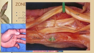 ZONE II-NO MANS LAND
 From metacarpal head to middle phalanx
 Called so because initial attempts for tendon repair here
produced poor results
 FDS and FDP within one sheath
 Adhesion formation risk is amplified at campers chiasma
 In each finger, the FDS tendon enters the A1 pulley and divides
into two equal halves that rotate laterally and then dorsally.
 The two slips rejoin deep to the FDP tendon over the distal
aspect of the proximal phalanx and the palmar plate of the PIP
joint at Camper's chiasma
 Insert as two separate slips on the volar aspect of the middle
phalanx.
 