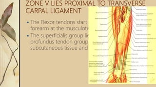 ZONE V LIES PROXIMAL TO TRANSVERSE
CARPAL LIGAMENT
 The Flexor tendons start in the distal third of the
forearm at the musculotendinous junction
 The superficialis group lies palmar to the conjoined
profundus tendon group covered by loose
subcutaneous tissue and skin.
 