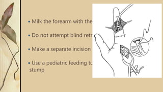  Milk the forearm with the wrist and MCP in flexion
 Do not attempt blind retrieval more than twice
 Make a separate incision if necessary
 Use a pediatric feeding tube to retrieve tendon
stump
 