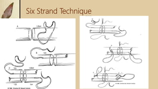 Six Strand Technique
 