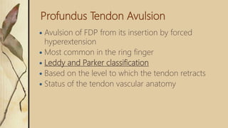 Profundus Tendon Avulsion
 Avulsion of FDP from its insertion by forced
hyperextension
 Most common in the ring finger
 Leddy and Parker classification
 Based on the level to which the tendon retracts
 Status of the tendon vascular anatomy
 