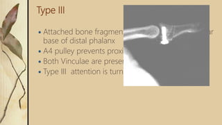 Type III
 Attached bone fragment that fractures off the volar
base of distal phalanx
 A4 pulley prevents proximal retraction
 Both Vinculae are preserved
 Type III attention is turned to ORIF
 