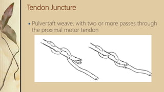 Tendon Juncture
 Pulvertaft weave, with two or more passes through
the proximal motor tendon
 