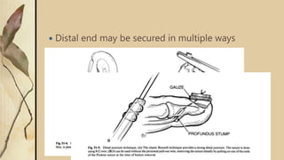  Distal end may be secured in multiple ways
 