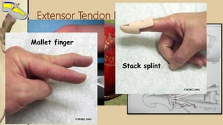 Extensor Tendon Injury
Extensor apparatus Extrinsic muscles (ED, EI, EDM)
 Intrinsic Muscles ( Lumbricals and Interossei)
 Fixed fibrous structures.
 Zone 1
 • Mallet finger – persistent flexon of distal phalanx
 • Closed: splinting 6-8 weeks
 • Open: suture repair, Soft tissue reconstruction
 