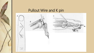 Pullout Wire and K pin
 