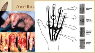 Zone II injury- Middle Phalanx Level:
 • Repair by interrupted suture.
 • Immobilization for 5-6 weeks
 • DIP joint in extension
 • PIP joint left free
 
