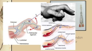Zone III injury- PIP joint level
 Most complex anatomically and physiologically
 Causes two deformities
 Boutonniere disruption of central tendon
 Closed: splinting MCP and PIP in hyperextension
for 6 weeks
 Open: suture repair (figure of 8 suture)
 Swan Neck excessive traction of central tendon
 Closed: splinting DIP & Open: suture repair
 