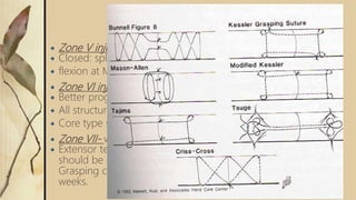  Zone V injury – MP joint level.
 Closed: splinting, 45 extension at wrist and 20
 flexion at MCP & Open: suture repair by 5.0 prolene
 Zone VI injury- Metacarpal level
 Better prognosis than in fingers
 All structures, even inter-tendinous band should be repaired.
 Core type suture possible. Delayed suture is possible.
 Zone VII- wrist level
 Extensor tendons are under dorsal retinaculum. Retinaculum
should be repaired or partially preserved. Adhesion is the
Grasping core suture should be used. Immobilization for 5-6
weeks.
 