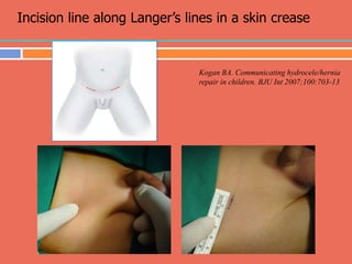 (05) HIL and Hydrocele management in children.ppt