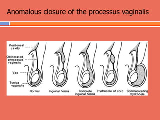 05 HIL And Hydrocele Management In Children ppt 05-hil-and-hydrocele-management-in-children-ppt