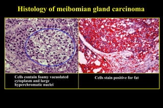 Histology of meibomian gland carcinoma Cells stain positive for fat Cells contain foamy vacuolated cytoplasm and large  hyperchromatic nuclei 