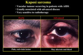 Kaposi sarcoma Advanced  Early Pink, red-violet lesion Vascular tumour occurring in patients with AIDS Usually associated with advanced disease Very sensitive to radiotherapy May ulcerate and bleed 