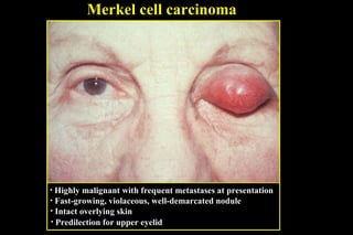 Merkel cell carcinoma Highly malignant with frequent metastases at presentation Fast-growing, violaceous, well-demarcated nodule Intact overlying skin Predilection for upper eyelid 