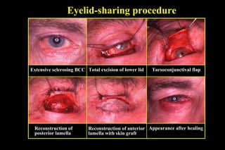 Eyelid-sharing procedure Reconstruction of posterior lamella Extensive sclerosing BCC Total excision of lower lid Tarsoconjunctival flap Reconstruction of anterior lamella with skin graft Appearance after healing 