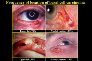 Frequency of location of basal cell carcinoma Lower lid - 70% Medial canthus - 15% Upper lid - 10% Lateral canthus  - 5% 