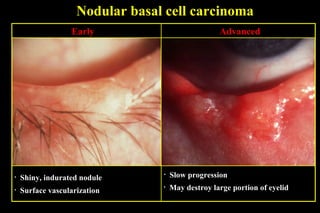Nodular basal cell carcinoma Early Shiny, indurated nodule Surface vascularization Slow progression Advanced May destroy large portion of eyelid 