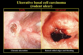 Ulcerative basal cell carcinoma (rodent ulcer) Early Chronic ulceration Advanced Raised rolled edges and bleeding 