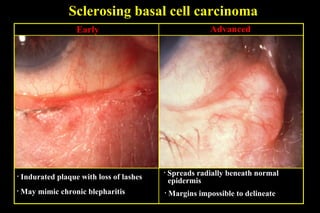 Sclerosing basal cell carcinoma Indurated plaque with loss of lashes Advanced  Spreads radially beneath normal  epidermis Early May mimic chronic blepharitis Margins impossible to delineate 